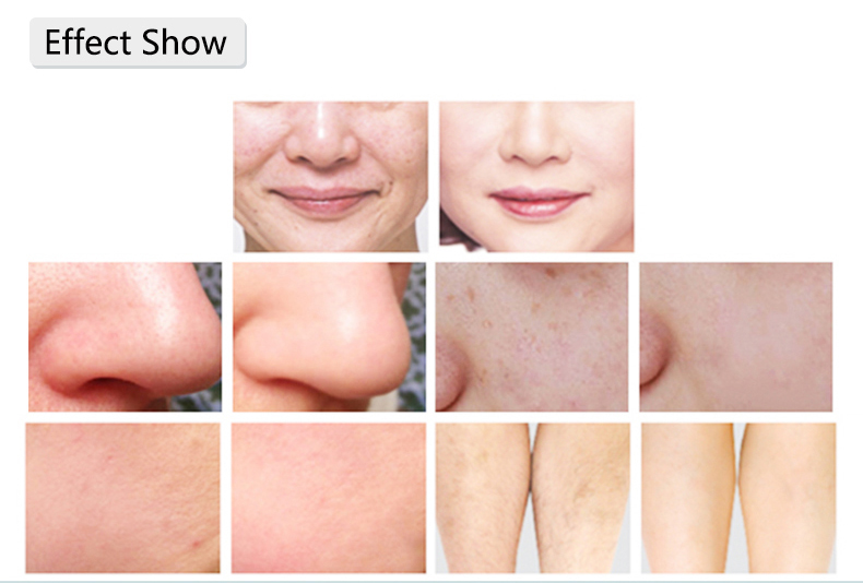 Skin Rejuvenation System.jpg