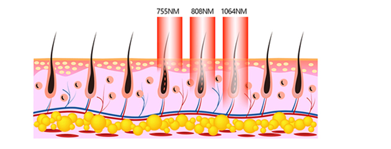 Laser Diode Hair Removal Machine