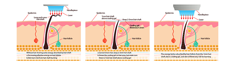 laser hair removal machine