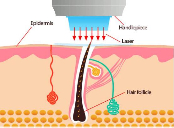Principle of Depilation Permanent Hair Removal