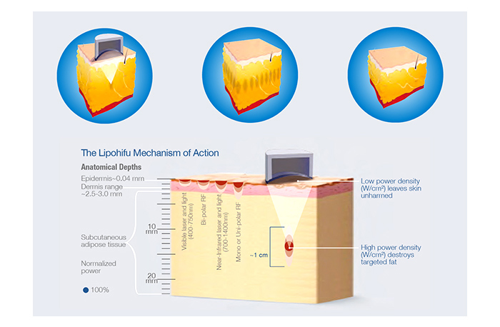 Liposonix Slimming Machine.jpg