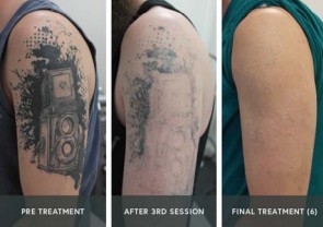 Wie viele PicoSure-Lasersitzungen entfernen ein Tattoo?