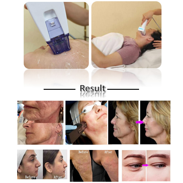 Machine multifonction pour l'élimination des rides 9D HIFU RF Microneedling Face Body Smash Lifting Hifu 