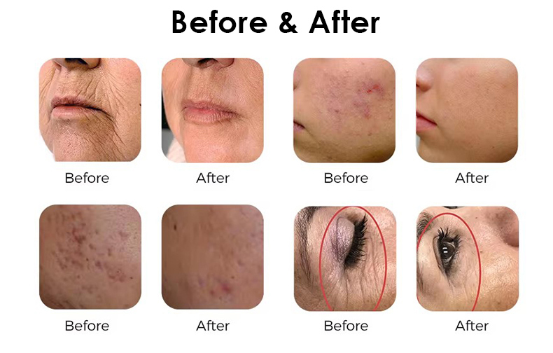 Skin Resurfacing 