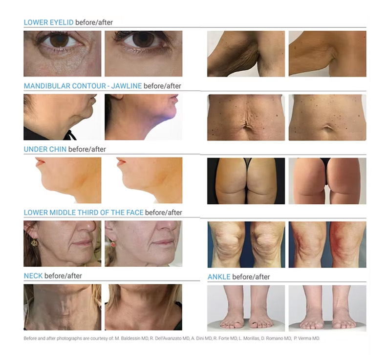 Liposuction Surgery Machine