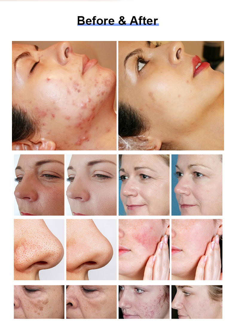 Skin Resurfacing.jpg