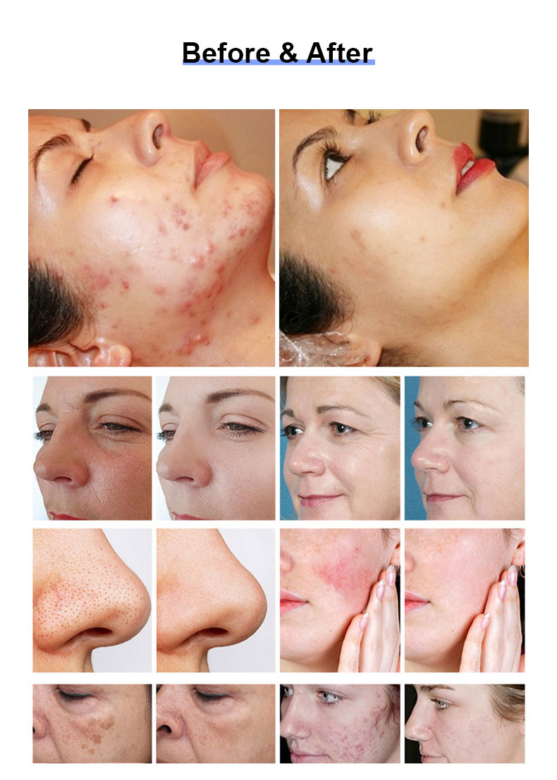 Skin Resurfacing.jpg